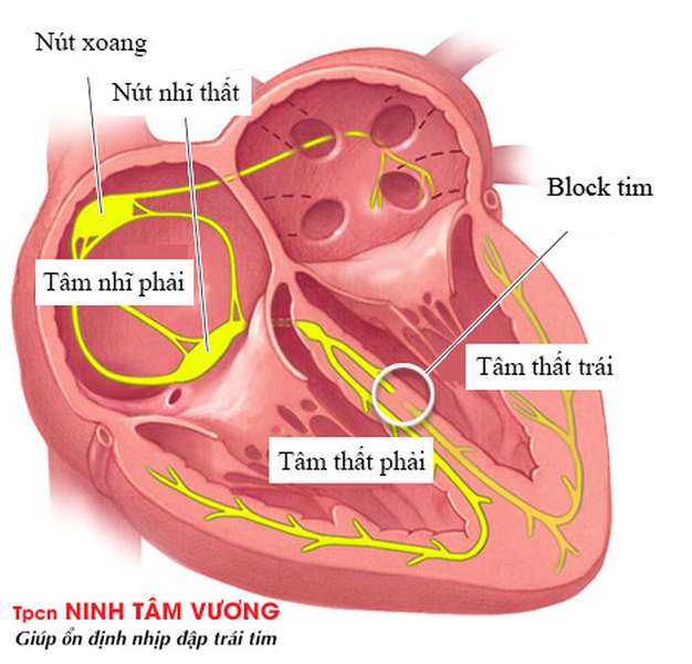 Blốc nhĩ thất - Hình ảnh minh họa
